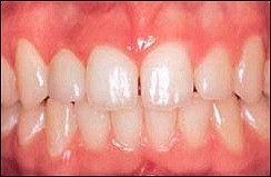 Dental_Implants_2.jpg